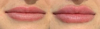 Dermal Fillers before and after photo