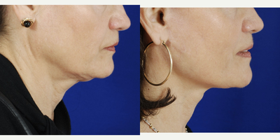 Facelift before and after photo