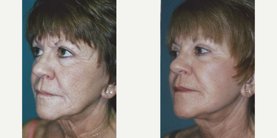 Facelift before and after photo