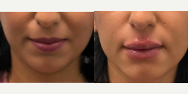 Juvederm before and after photo
