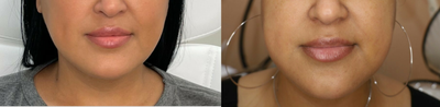 Kybella before and after photo