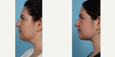 PrecisionTx before and after photo