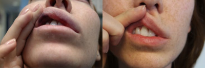 Vbeam before and after photo