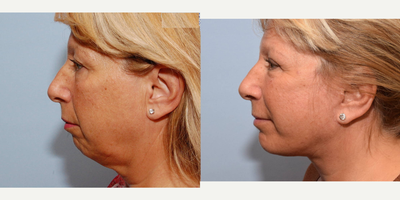 Chin Implant before and after photo
