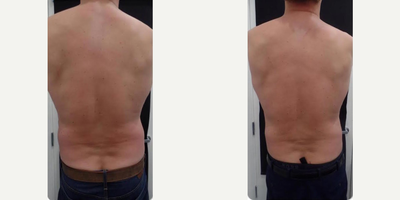 CoolSculpting before and after photo