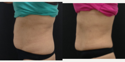 Emsculpt before and after photo