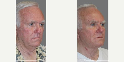 Facelift before and after photo