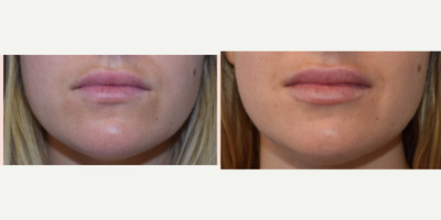 Juvederm before and after photo