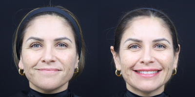 Lip Fillers before and after photo