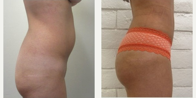 Liposuction before and after photo