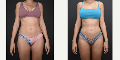 Power-Assisted Liposuction (PAL) before and after photo