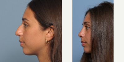 Rhinoplasty before and after photo