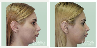 Transgender Facial Feminization Surgery before and after photo