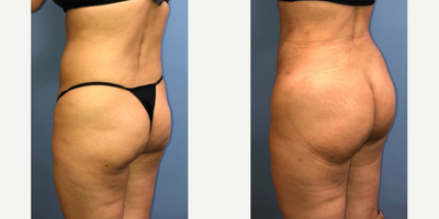 Brazilian Butt Lift before and after photo