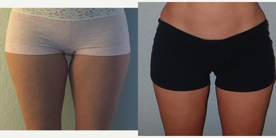 CoolSculpting before and after photo