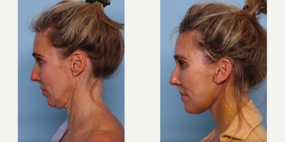 Dermal Fillers before and after photo