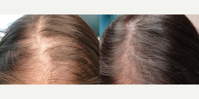 Hair Loss Treatment before and after photo