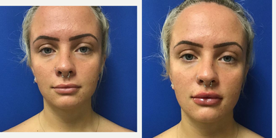 Lip Fillers before and after photo