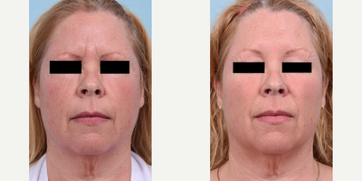 Botox before and after photo