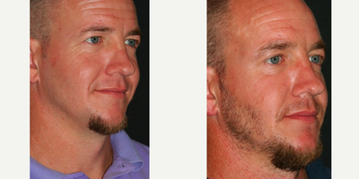 Brow Lift before and after photo