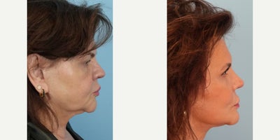 Facelift before and after photo