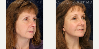 SMAS Facelift before and after photo