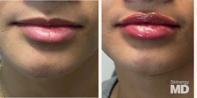 Dermal Fillers before and after photo