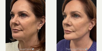 Facelift before and after photo