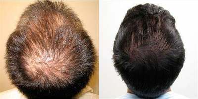 Hair Transplant before and after photo