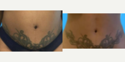 Laser Liposuction before and after photo