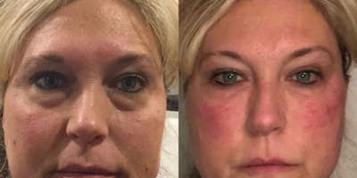 Vampire Facelift before and after photo