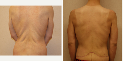 Body Lift before and after photo