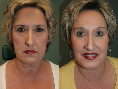 Brow Lift before and after photo