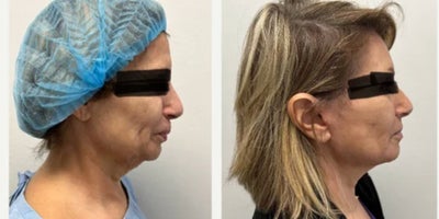 Mini Facelift before and after photo