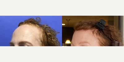 Transgender Facial Feminization Surgery before and after photo