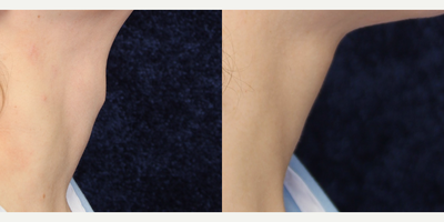 Adam's Apple Reduction before and after photo