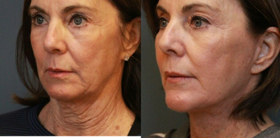 Deep Plane Facelift before and after photo