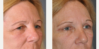 Eyelid Surgery before and after photo