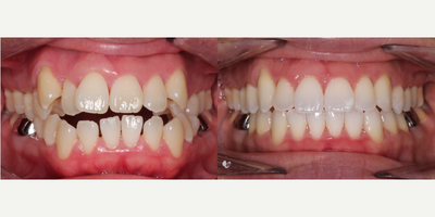 Invisalign before and after photo