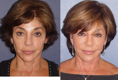 Sculptra before and after photo