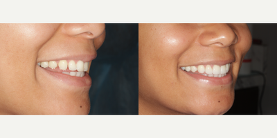 Teeth Whitening before and after photo