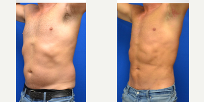 Abdominal Etching before and after photo