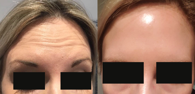 Botox before and after photo