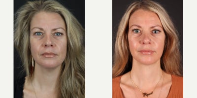 before and after image