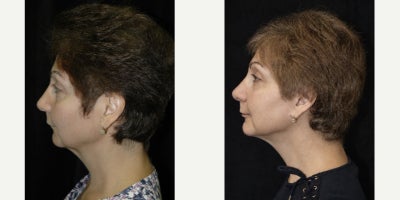 Neck Lift before and after photo