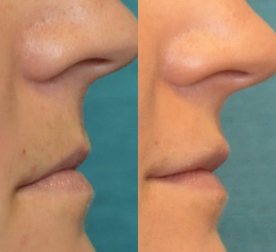 Restylane Defyne before and after photo