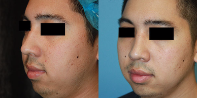 Rhinoplasty before and after photo