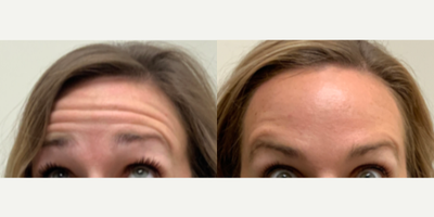Botox before and after photo