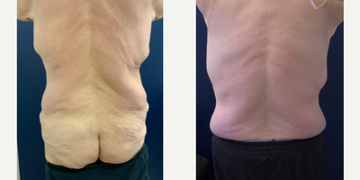 Male Tummy Tuck before and after photo