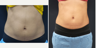 SculpSure before and after photo